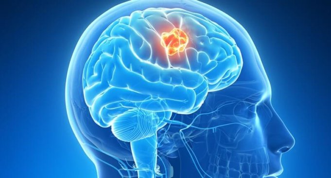 What Is A Brain Tumor :malignant Brain Tumor 